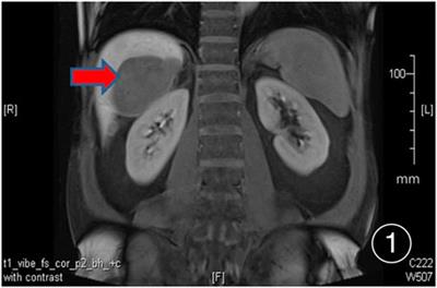 Clinical and pathological observation of conversion therapy for malignant peritoneal mesothelioma: a case report and literature review